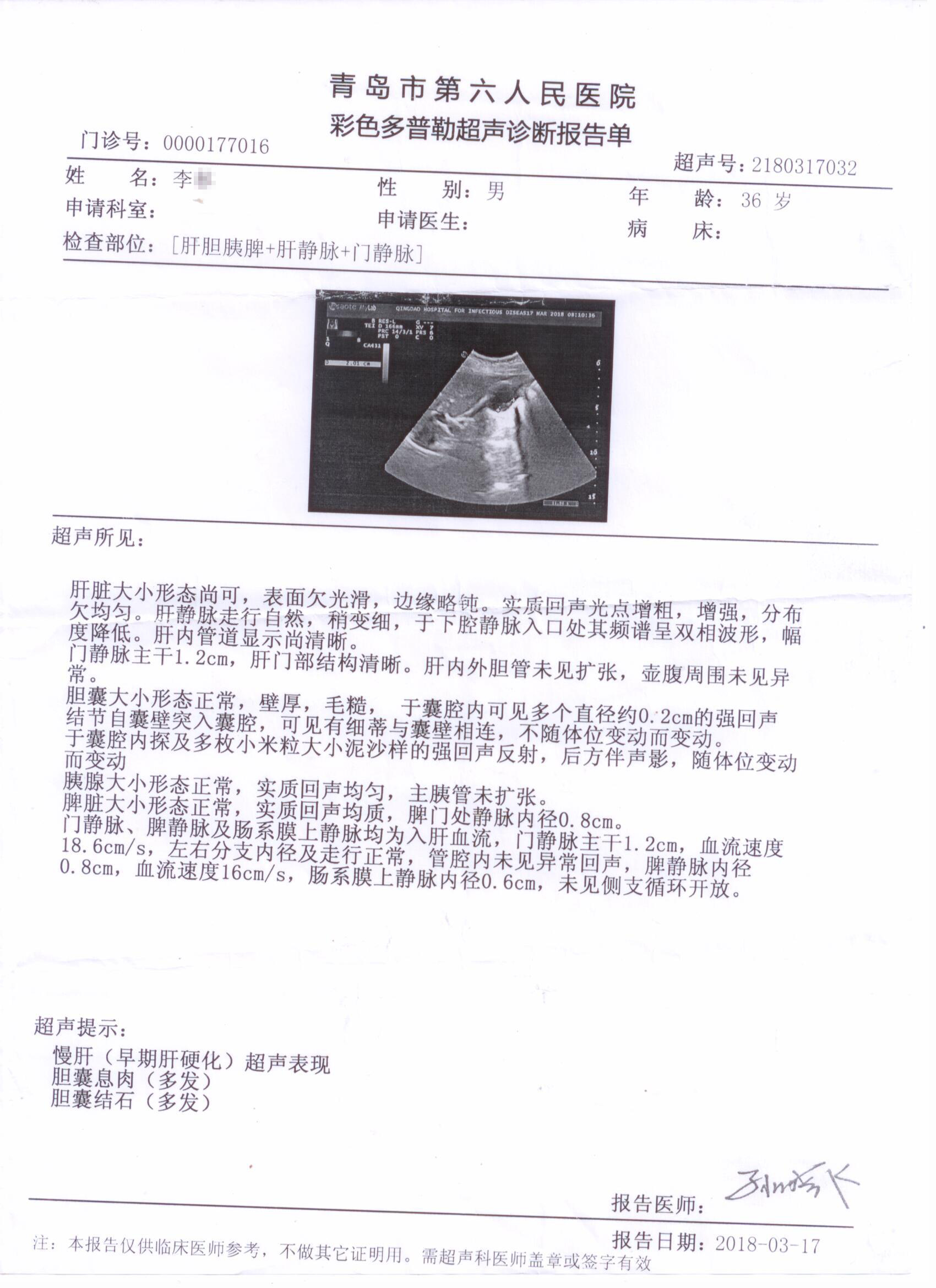 患者:青岛李先生(早期肝硬化)